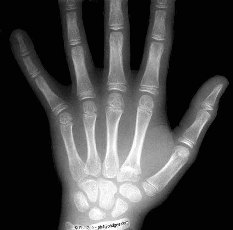 X-ray Hand © Phil Gee
